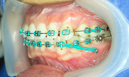 orthodontic patient requires temporary anchorage device