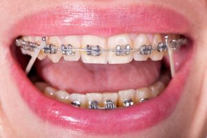 self-ligating braces