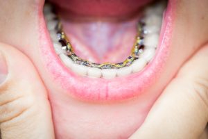 patient wearing lingual braces