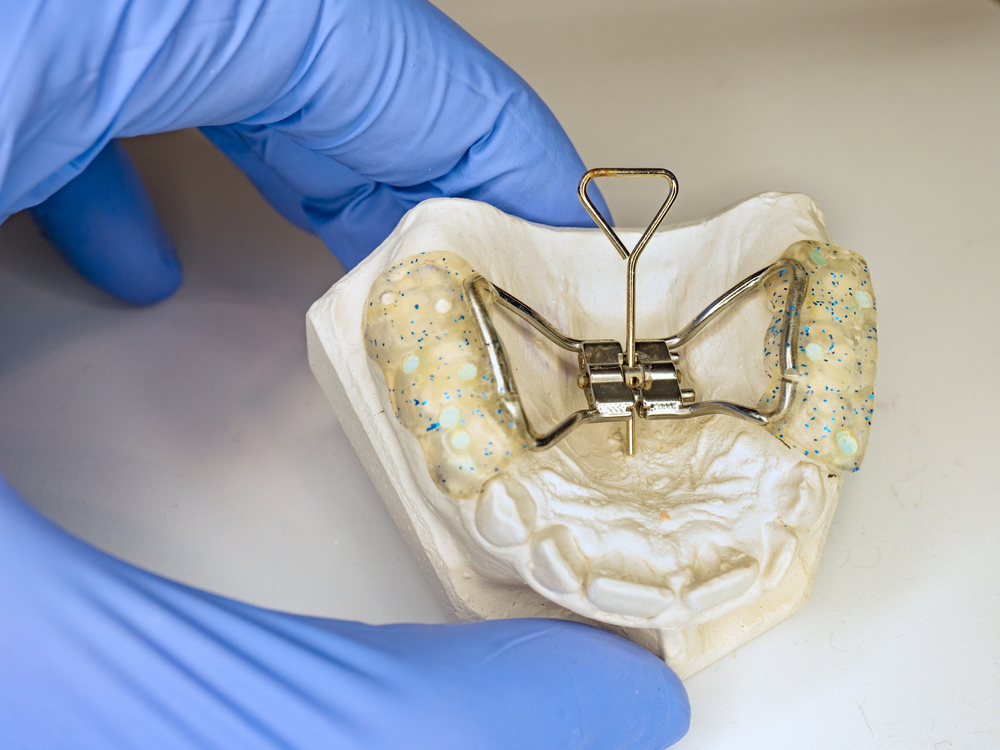palatal expander on model of teeth