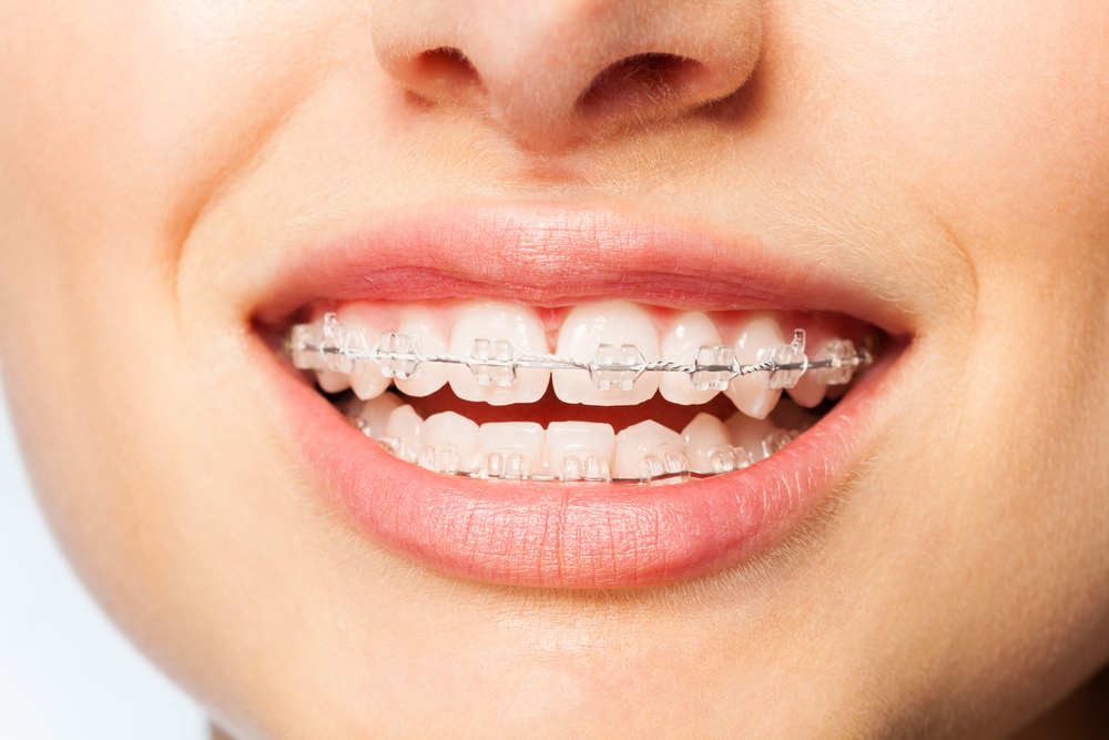 woman wearing ceramic braces